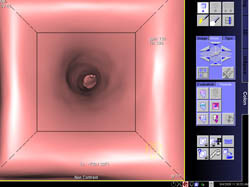 Endoluminal View of the Airway With Stents - CTisus CT Scan