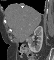 Benign Calcified Plaque on Disphragm - CTisus CT Scan