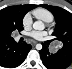 Necrotic Nodes in Tuberculosis (TB) Vs Testicular Cancer - CTisus CT Scan