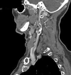 Stenosis of Subclavian Artery - CTisus CT Scan