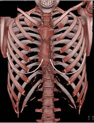 Pectus Deformity Preop Planning - CTisus CT Scan