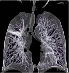 Stenosis of Right Mainstem Branching Due to Inflammation - CTisus CT Scan