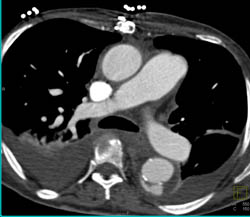 Type B Dissection - CTisus CT Scan