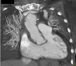 Bleed Into Intramural Hematoma - CTisus CT Scan