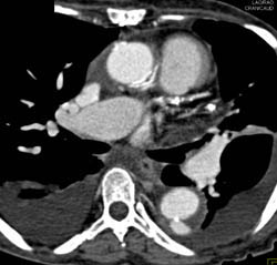 Intramural Ulcer - CTisus CT Scan