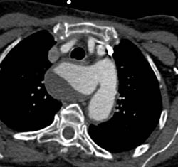 Aberrant Left Subclavian Artery With Aneurysmal Dilation - CTisus CT Scan