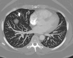 Pulmonary Arteriovenous Malformation (PAVM) Including Embolization of A Few PAVMs - CTisus CT Scan