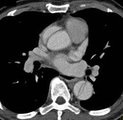 Type A Dissection - CTisus CT Scan