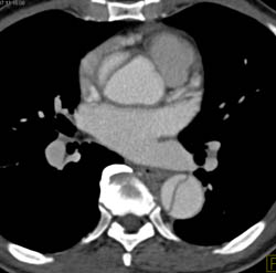 Type A Dissection - CTisus CT Scan