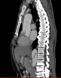 Type A Dissection - CTisus CT Scan