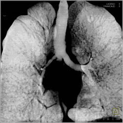 Lung Transplant With Stent and Stenosis Left Mainstem Bronchus - CTisus CT Scan