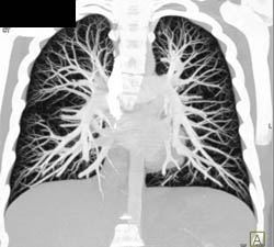 Pulmonary Arteriovenous Malformation (PAVM) - CTisus CT Scan