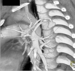 Pulmonary Arteriovenous Malformation (PAVM) - CTisus CT Scan