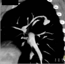 Pulmonary Arteriovenous Malformation (PAVM) - CTisus CT Scan