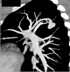 Pulmonary Arteriovenous Malformation (PAVM) - CTisus CT Scan