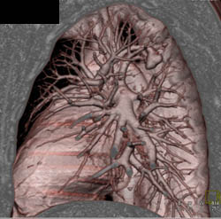 Pulmonary Arteriovenous Malformation (PAVM) - CTisus CT Scan