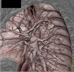 Pulmonary Arteriovenous Malformation (PAVM) - CTisus CT Scan