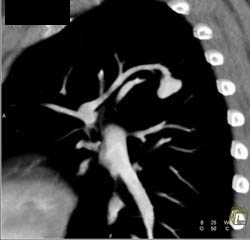 Pulmonary Arteriovenous Malformation (PAVM) - CTisus CT Scan