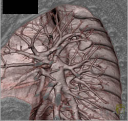 Pulmonary Arteriovenous Malformation (PAVM) - CTisus CT Scan