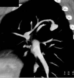 Pulmonary Arteriovenous Malformation (PAVM) - CTisus CT Scan