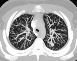 Pulmonary Arteriovenous Malformation (PAVM) in Right Upper Lobe - CTisus CT Scan