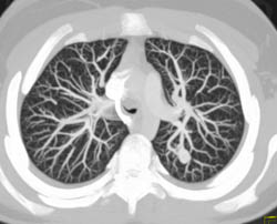 Pulmonary Arteriovenous Malformation (PAVM) - CTisus CT Scan