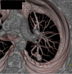 Pulmonary Arteriovenous Malformation (PAVM) - CTisus CT Scan