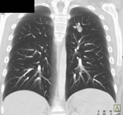 Pulmonary Arteriovenous Malformation (PAVM) - CTisus CT Scan