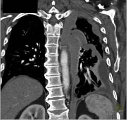 Pleural Tumor Infiltration - CTisus CT Scan