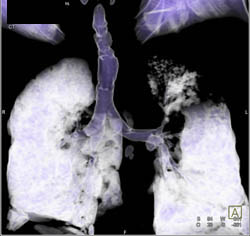 Ct Bronchoscopy With Bronchiectasis With Stenosis Left Upper Lobe Bronchus - CTisus CT Scan