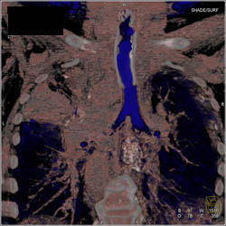 Stent in Airway With Narrowed Left Upper Lobe Branches - CTisus CT Scan