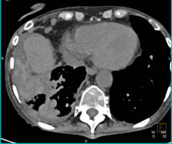 Renal Cell Cancer With Adrenal and Pleural Metastases - CTisus CT Scan