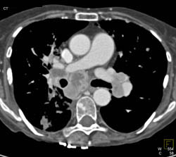 Renal Cell Cancer With Bone and Breast Metastases - CTisus CT Scan