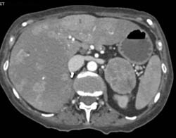 Renal Cell Carcinoma With Liver, Adrenal, and Bone Metastases - CTisus CT Scan