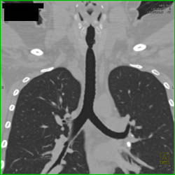 Ct Bronchoscopy With Thickening on Left Near Thoracic Inlet - CTisus CT Scan