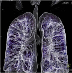 Ct Bronchoscopy With Septic Emboli - CTisus CT Scan