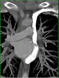 Left SVC and Aneurysm of Circumflex Coronary Artery Empties Into Coronary Sinus - CTisus CT Scan