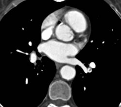 Pulmonary Embolism - CTisus CT Scan