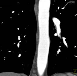 Pulmonary Embolism - CTisus CT Scan