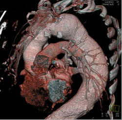 Descending Thoracic Aneurysm - CTisus CT Scan