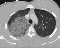 Pulmonary Hemorrhage - CTisus CT Scan