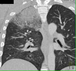 Pulmonary Hemorrhage - CTisus CT Scan