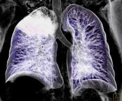 Pulmonary Hemorrhage - CTisus CT Scan