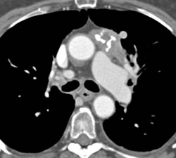 Thymoma - CTisus CT Scan