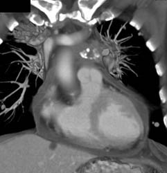 Thymoma - CTisus CT Scan