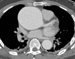 Dilated Aortic Root - CTisus CT Scan