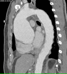 Dilated Aortic Root - CTisus CT Scan