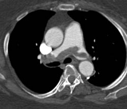 Huge Pulmonary Embolism - CTisus CT Scan