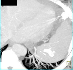 Prior Embolization of Pulmonary Arteriovenous Malformation (PAVM) With Residual PAVMs - CTisus CT Scan