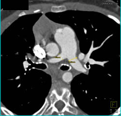 Pulmonary Artery Stenosis- Keutel Syndrome - CTisus CT Scan